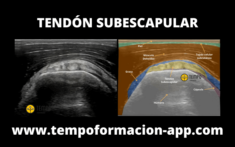 Tendon Subescapular Ultrasound.png